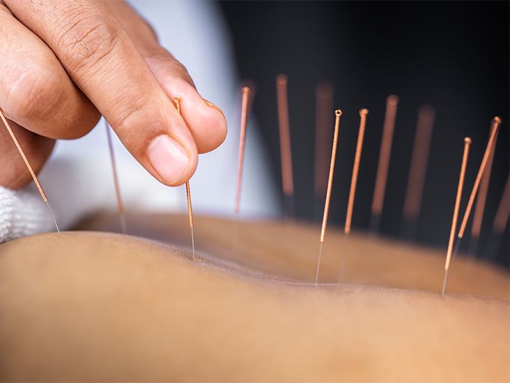 Pacess Acupuncture Academy Kannur