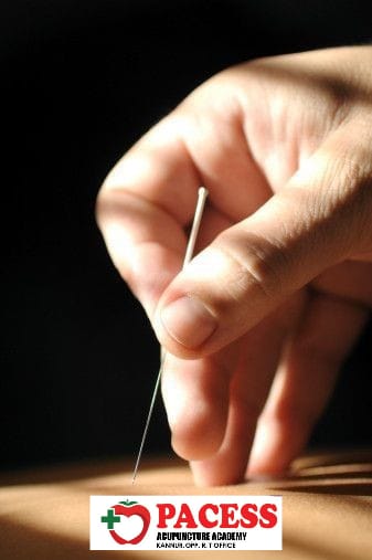 Pacess Acupuncture Academy Kannur
